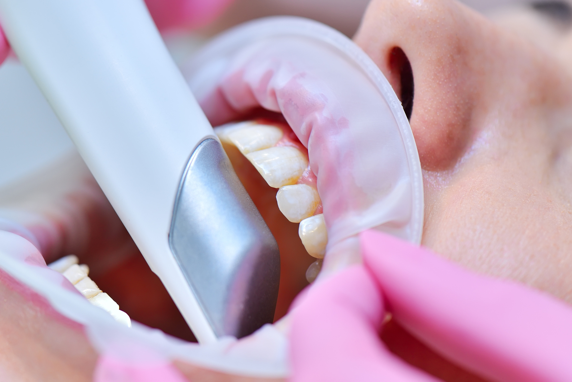 Dentist Doing Dental Scanning of Patients Teeth
